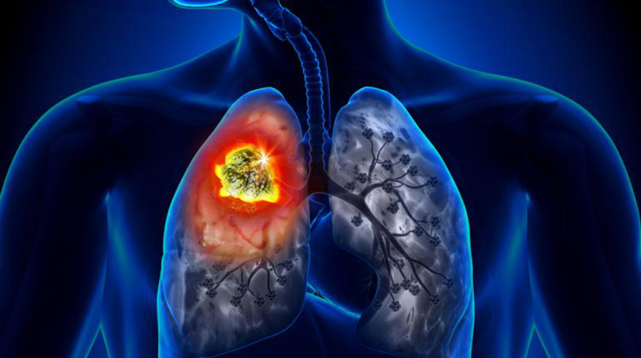 肺癌和慢阻肺